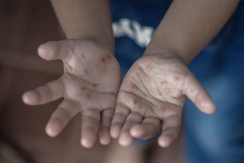 Imigrante registra aumento de casos de mão-pé-boca e reforça orientações à famílias e escolas